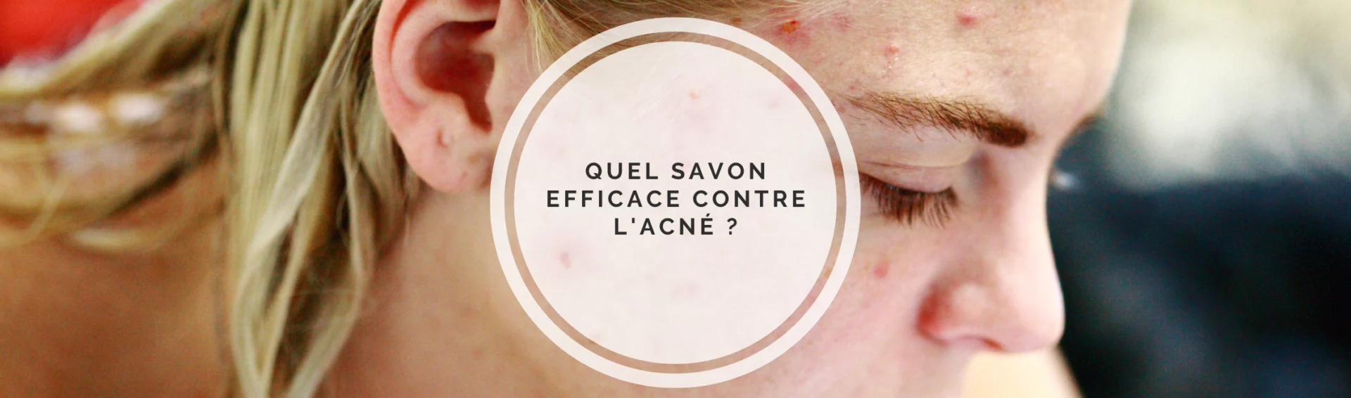 Quel savon efficace contre l’acné ?
