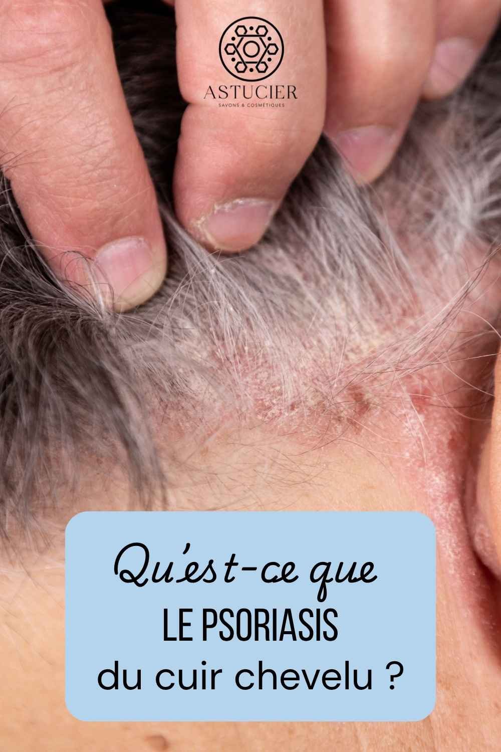 shampoing psoriasis (1)