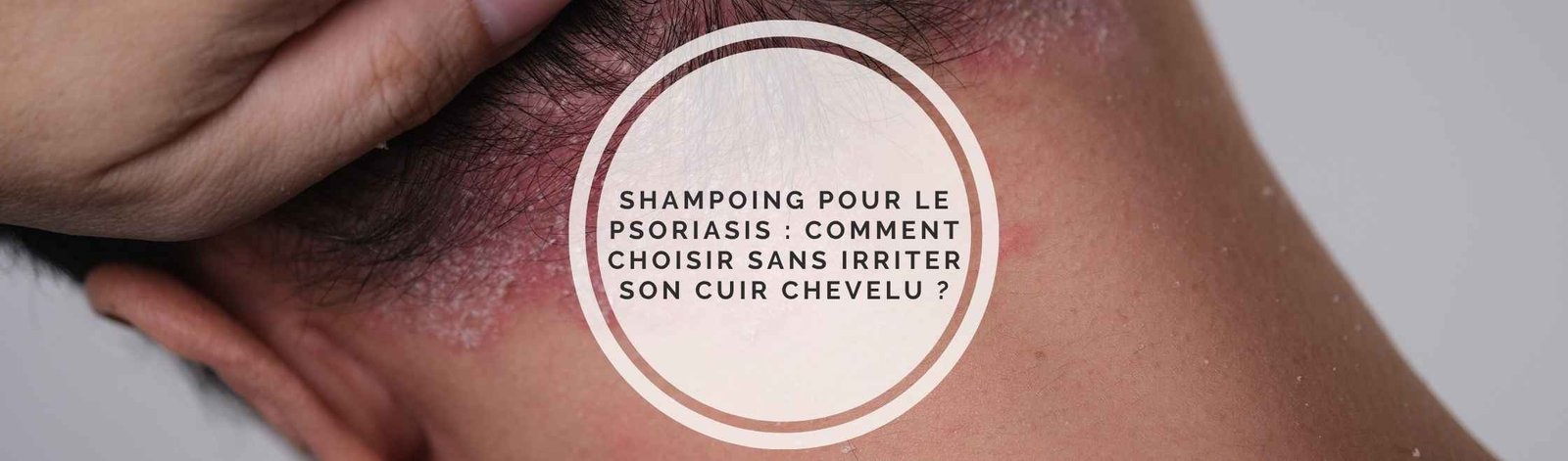 shampoing psoriasis